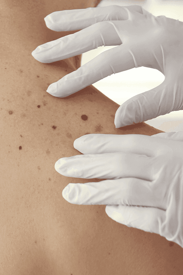 Será que é câncer de pele? Saiba como identificar pintas suspeitas