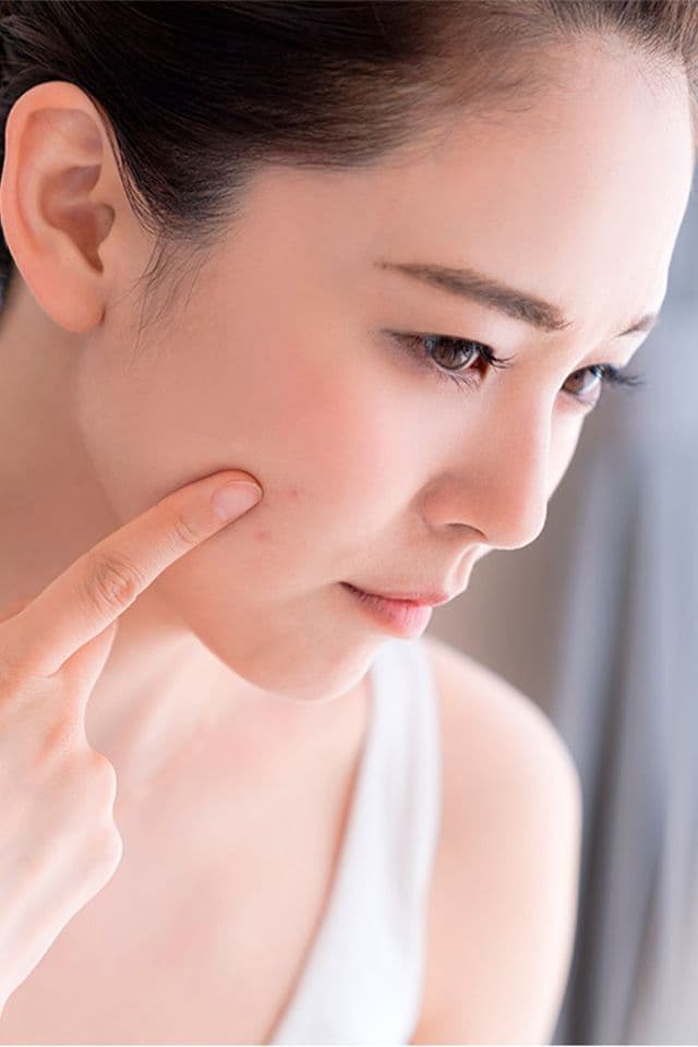 Conheça os principais motivos da acne durante a fase adulta da mulher e saiba como tratá-la