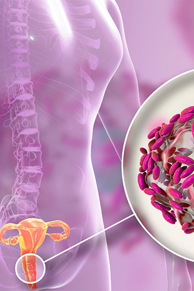 Vaginose Bacteriana: Conheça Causas, Sintomas E Tratamentos